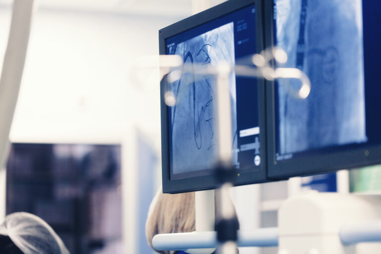 Minimally invasive cardiology transcatheter closure treatment for patent foramen ovale PFO defects with occluder, using a endovascular minimally invasive procedure with cardiovascular imaging system